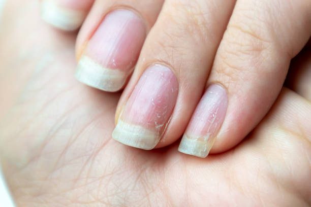 Nail White Spots? Discover Causes And Secrets To Healthy Nails