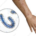 Marburg Virus That You Should Know